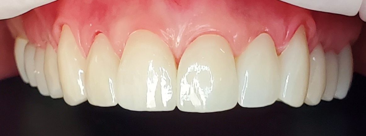 Cosmetic dentistry after treatment at Elm Ridge Implant and Family Dentistry in Killeen, TX